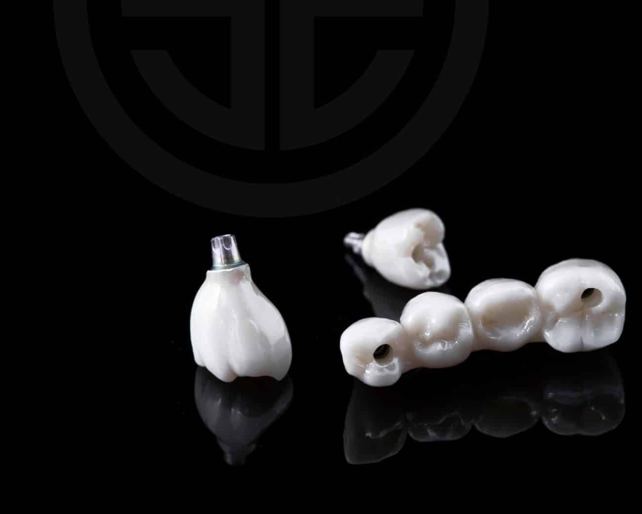 Bridge sur implants : technique de soins prothétiques | Dr Elhyani | Paris