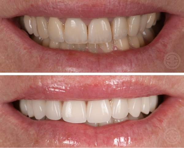 Facette dentaire refaite. Amélioration de la luminosité et des formes pour rajeunir le sourire