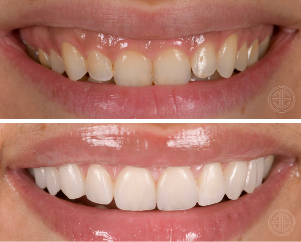 pose facettes dentaires pour embellir le sourire sans diminuer les dents